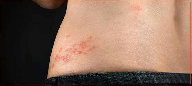 shingles symptoms treatment